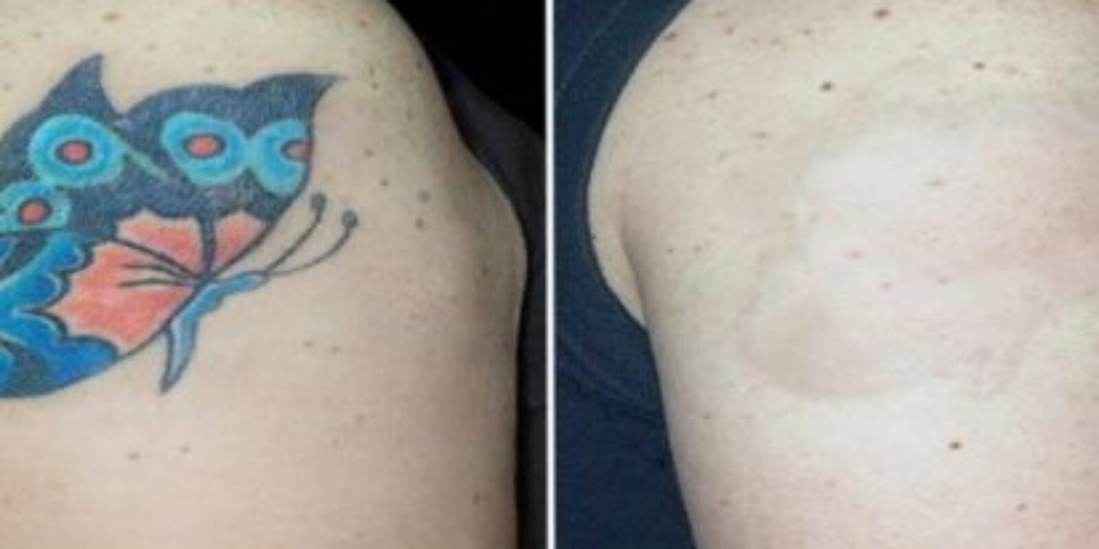 Here Are Todays Best Ideas for Tattoo Removal Products