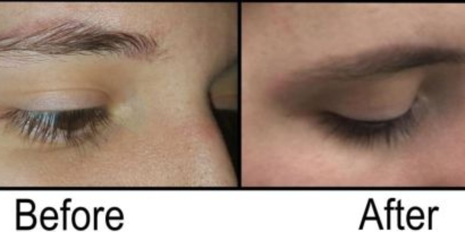 What are the Different Options to Remove Eyebrow Tattoos